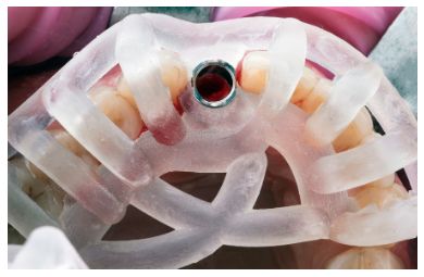 IMPLANTES DENTALES heredia